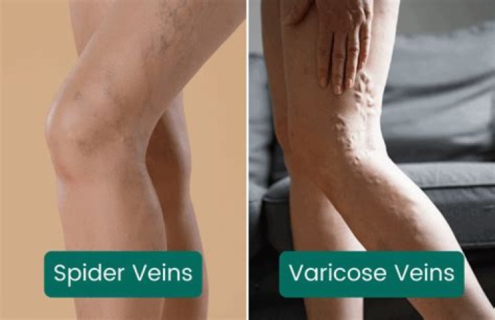 Are spider veins ever covered by insurance?