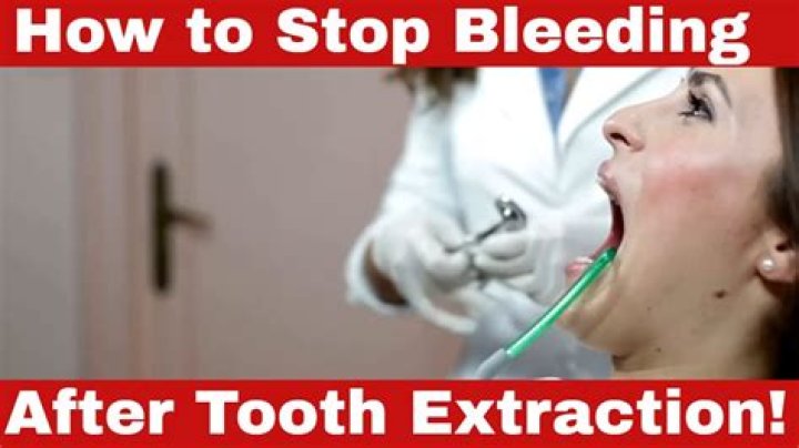 How long does it take for bleeding to stop after dental surgery?