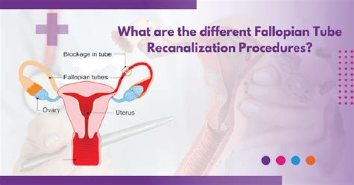 How much does it cost to get your fallopian tubes untied?